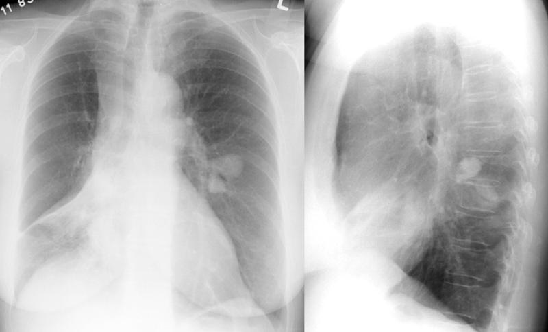 X-ray, COPD, Chronic Obstructive Disease, Asthma, Anterior, Lateral
