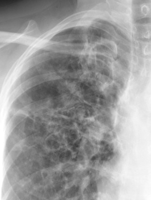 X-ray, COPD, Chronic Obstructive Pulmonary Disease, ABPA, Allergy Bronchopulmonary Aspergillosis, Close up 