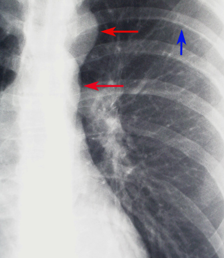 <p>Coarctation of the Aorta Demonstrated on Chest Radiograph