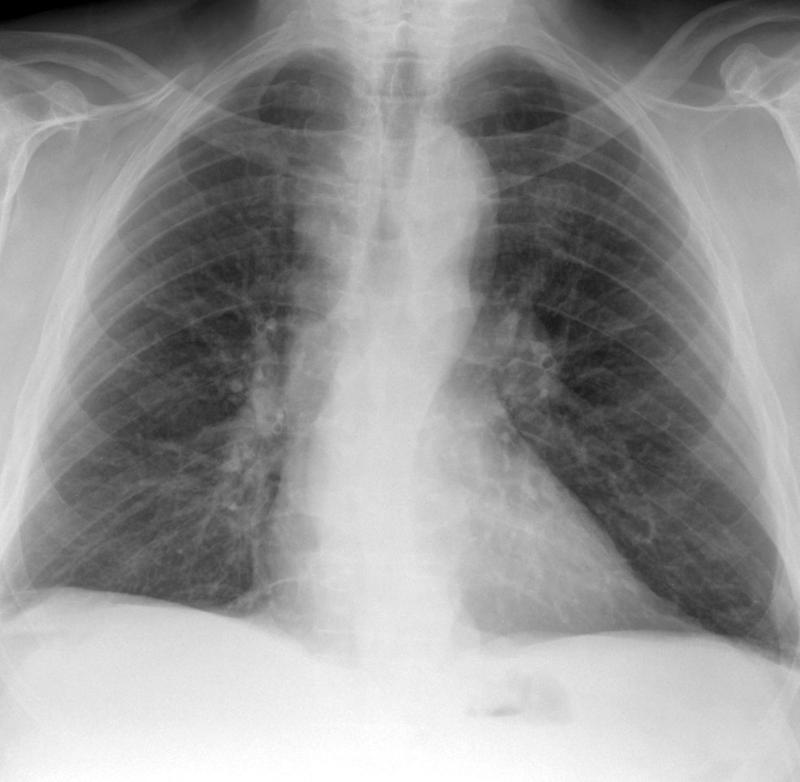 X-ray, Cardiac, Double Aortic Arch