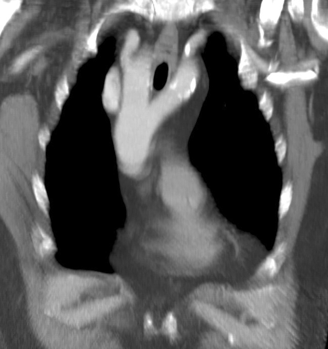 CT Scan, Cardiac, Double Aortic Arch 