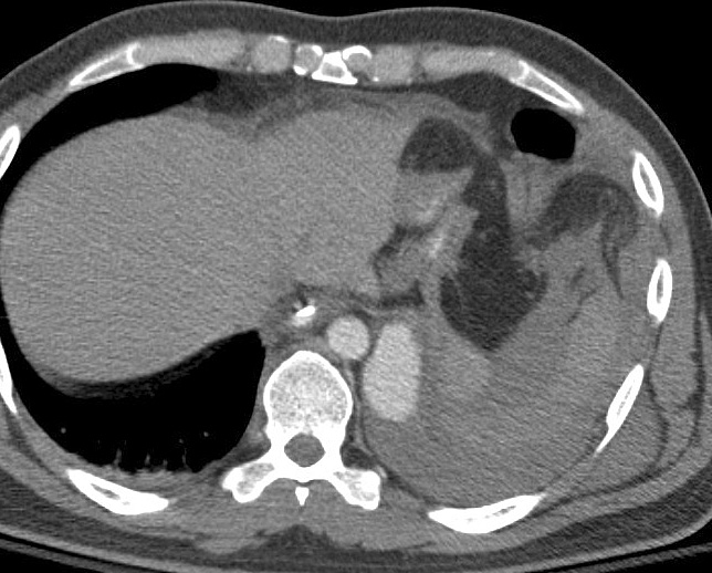 CT Scan, Cardiac, Blunt Chest Trauma, Rupture