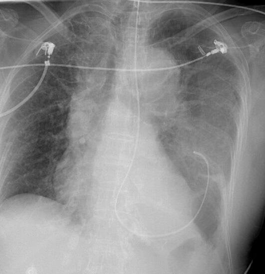 X-ray, Blunt Chest Trauma, Rupture