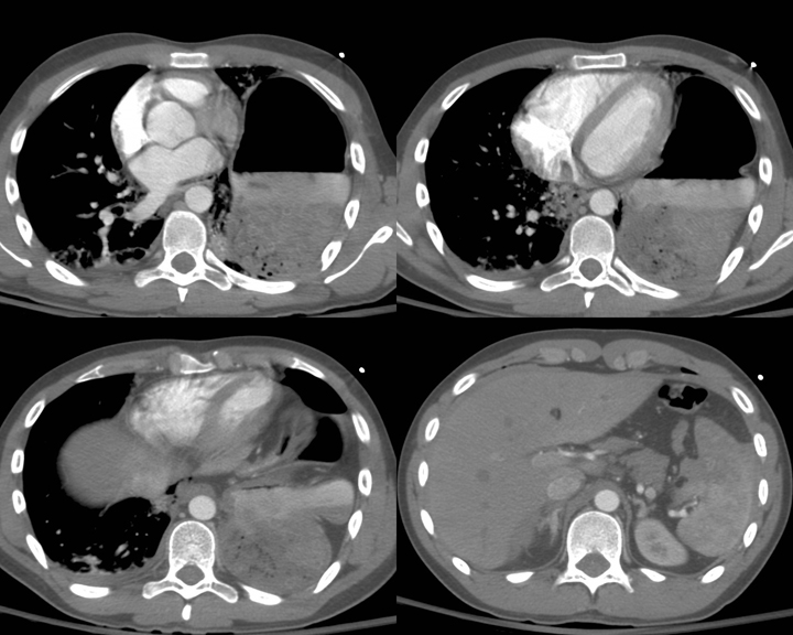 <p>Blunt Chest Trauma on Computed Tomography