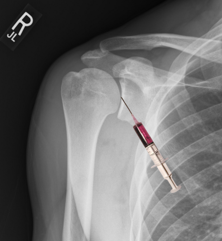 Schematic showing the entry point and anatomy for arthrocentesis of the shoulder, anterior approach