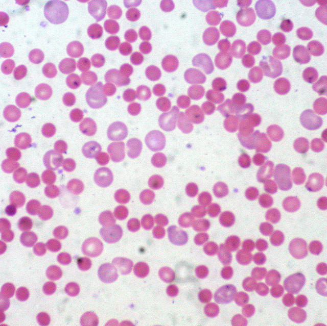 Reticulocytes, Polychromatic, polychromatophilic, red blood cell, Romanowsky, Stain, peripheral blood, hemolytic anemia