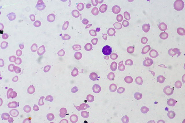 Reticulocytes, Anemia, IDA, Iron Deficiency Anemia, Hematopathology, Microcytosis, Hypochromia