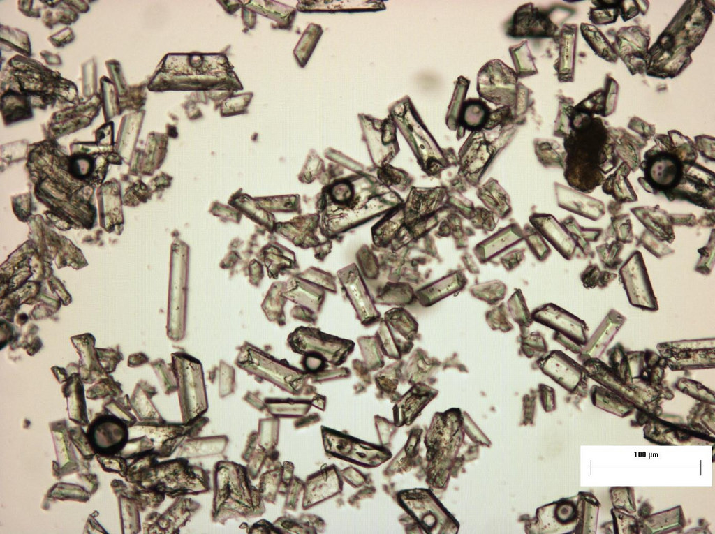 Triple Phosphate Crystals, Urine