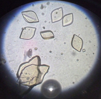 <p>Uric Acid Crystals, Rosette-Shaped. The image shows rosette-shaped uric acid crystals on light microscopy.</p>