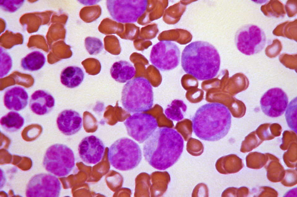 Blast crisis, Leukemia, CML