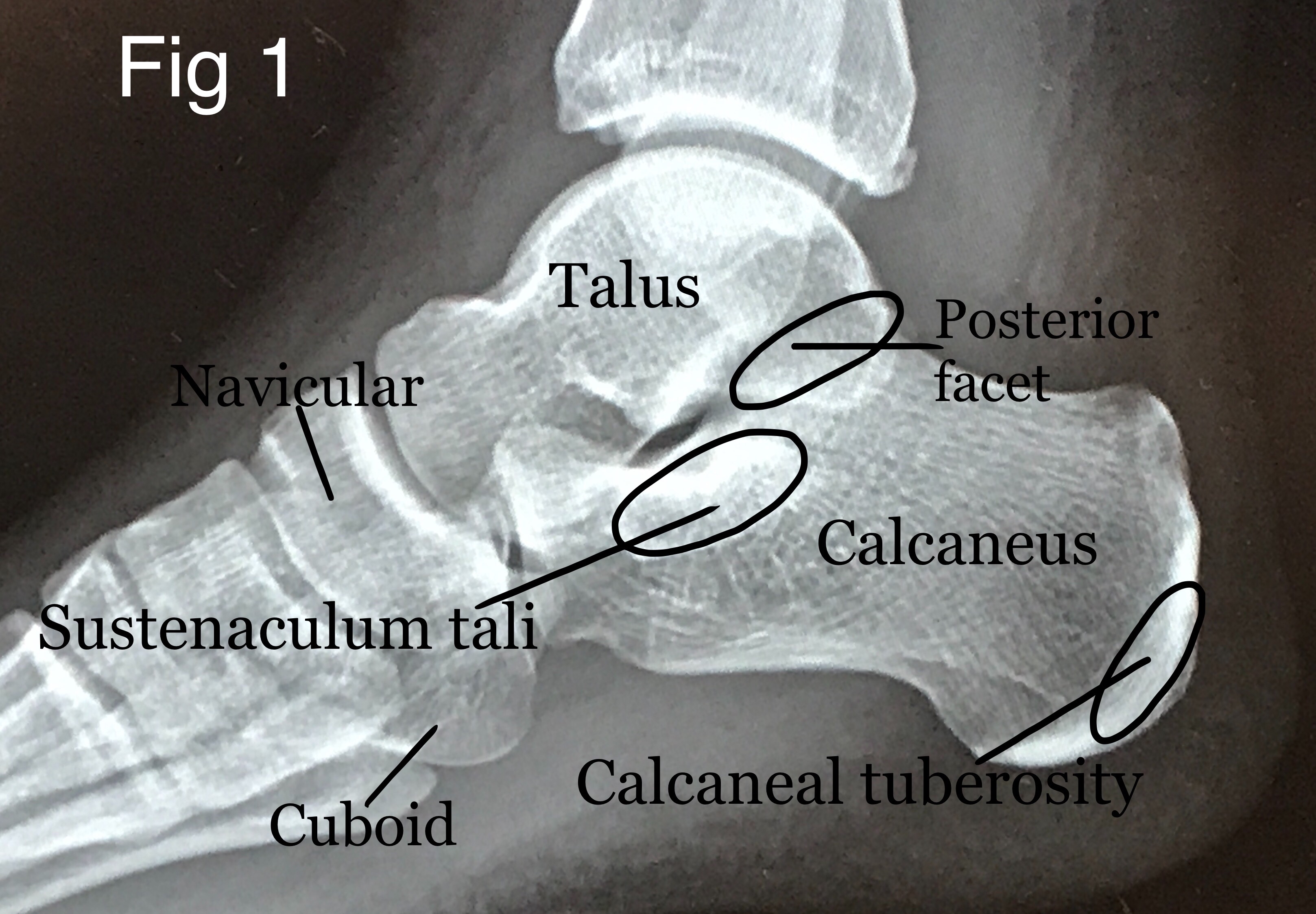 Calcaneus Anatomy