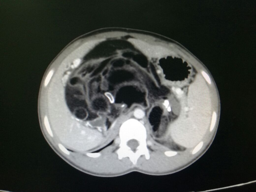 A large adrenal myelolipoma with predominantly fatty and intermixed intermediately attenuating components  seen on CT