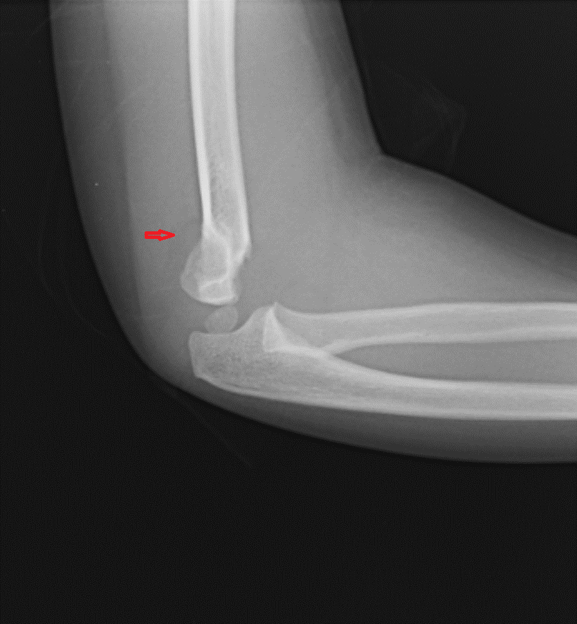 Posterior fat pad sign (supracondylar fracture)