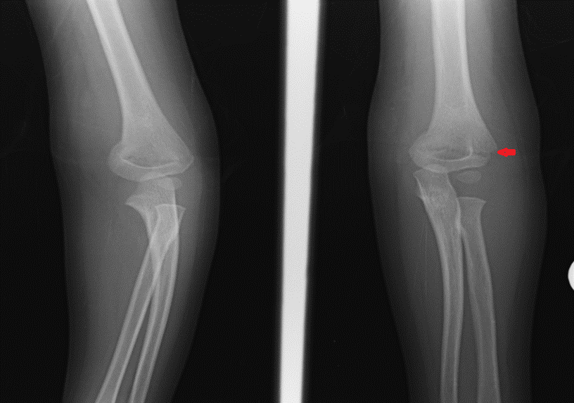 Supracondylar fracture with dorsal angulation and medial displacement of the distal fracture fragment