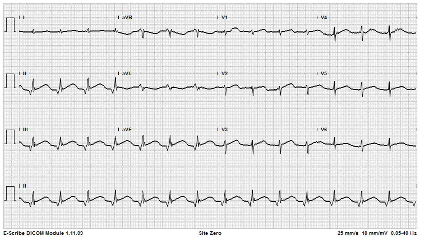 Prolonged QT interval in a patient admitted for COPD exacerbation, after use of propofol.