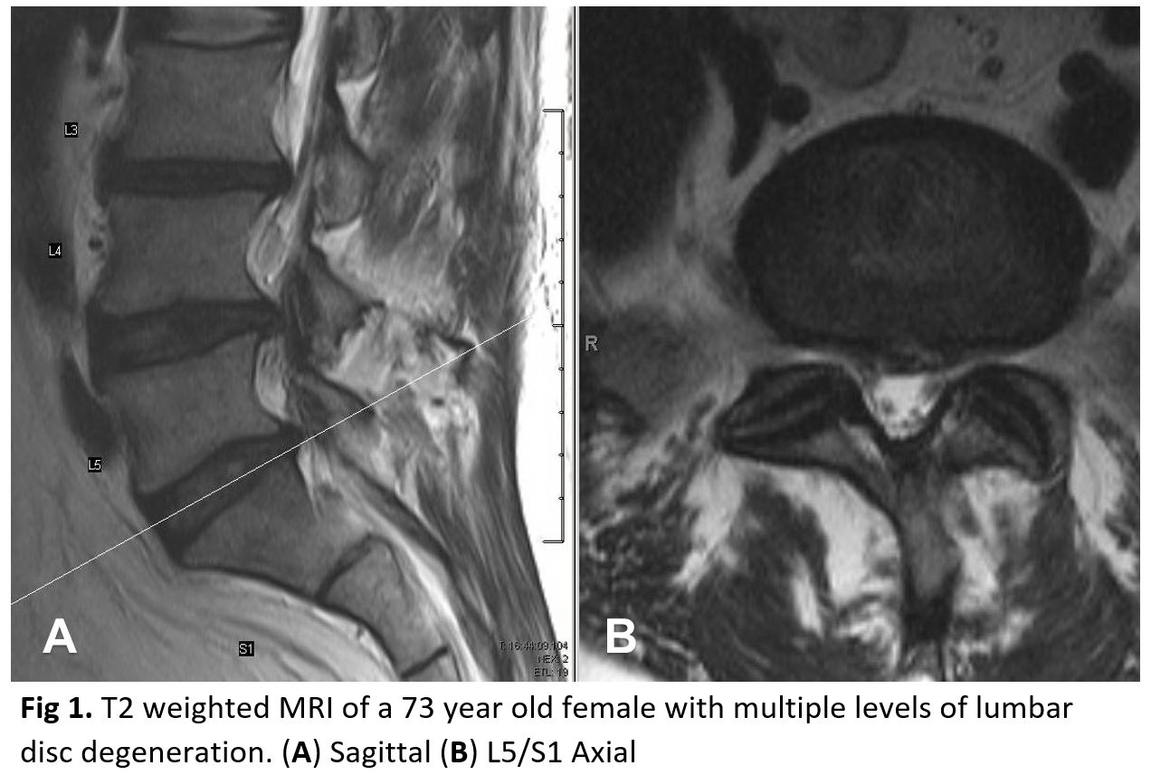 <p>Lumbar Disc Degeneration, Multiple Levels