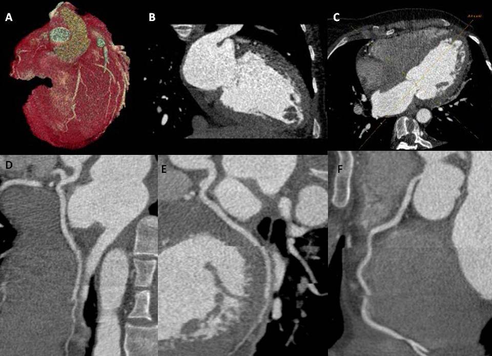 CCTA imaging, (A) represents a three-dimensional volume rendered image of the heart, (C); represent oblique planar images of the heart,  (B) at the apex, likely consistent with an intracavitary thrombus