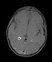 Right occipital and temporal leptomeningeal enhancement with enlarged choroid plexus in a patient with Sturge-Weber syndrome.