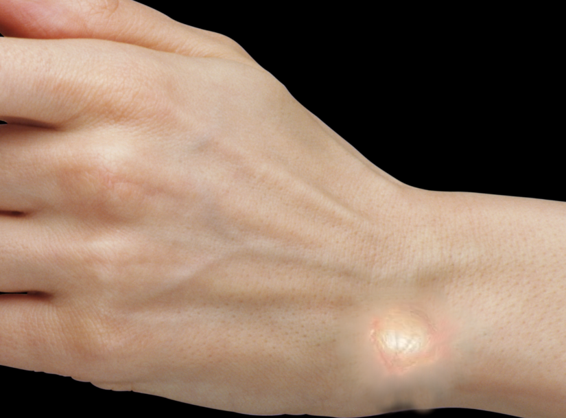 Ganglion Cyst