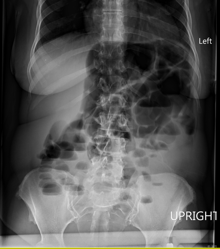 FIGURE 2: Sigmoid volvulus