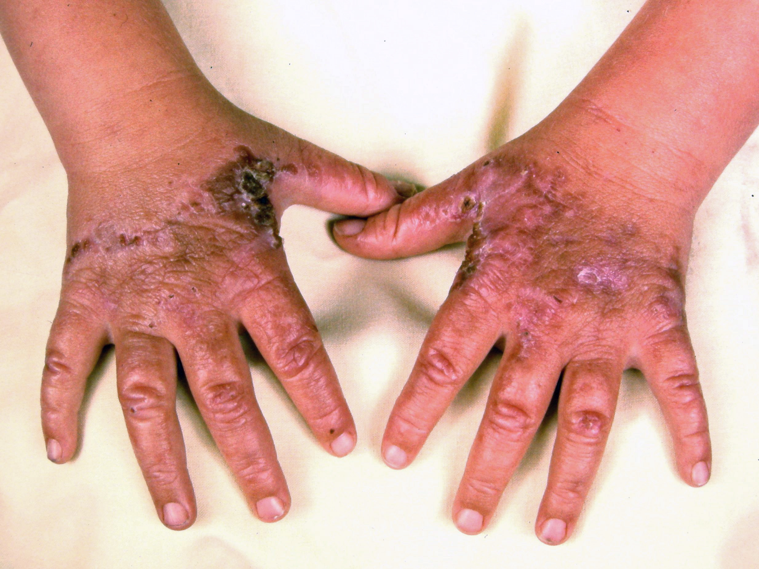 Acute sunburn reaction in young child with erythropoeitic protoporphyria