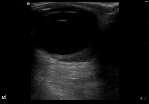 Retrobulbar hematoma (ultrasound image)