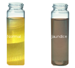 Normal Urine Color Versus Jaundice/Tea Colored Urine