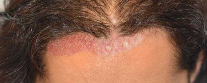 Seborrheic Dermatitis