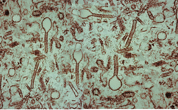 Histiocytosis microscopy