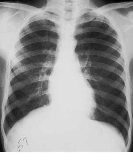 <p>Upper Lobe Pneumothorax</p>