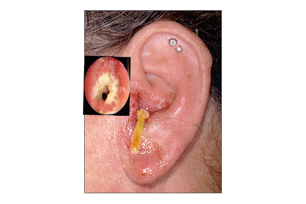 <p>Otitis Externa