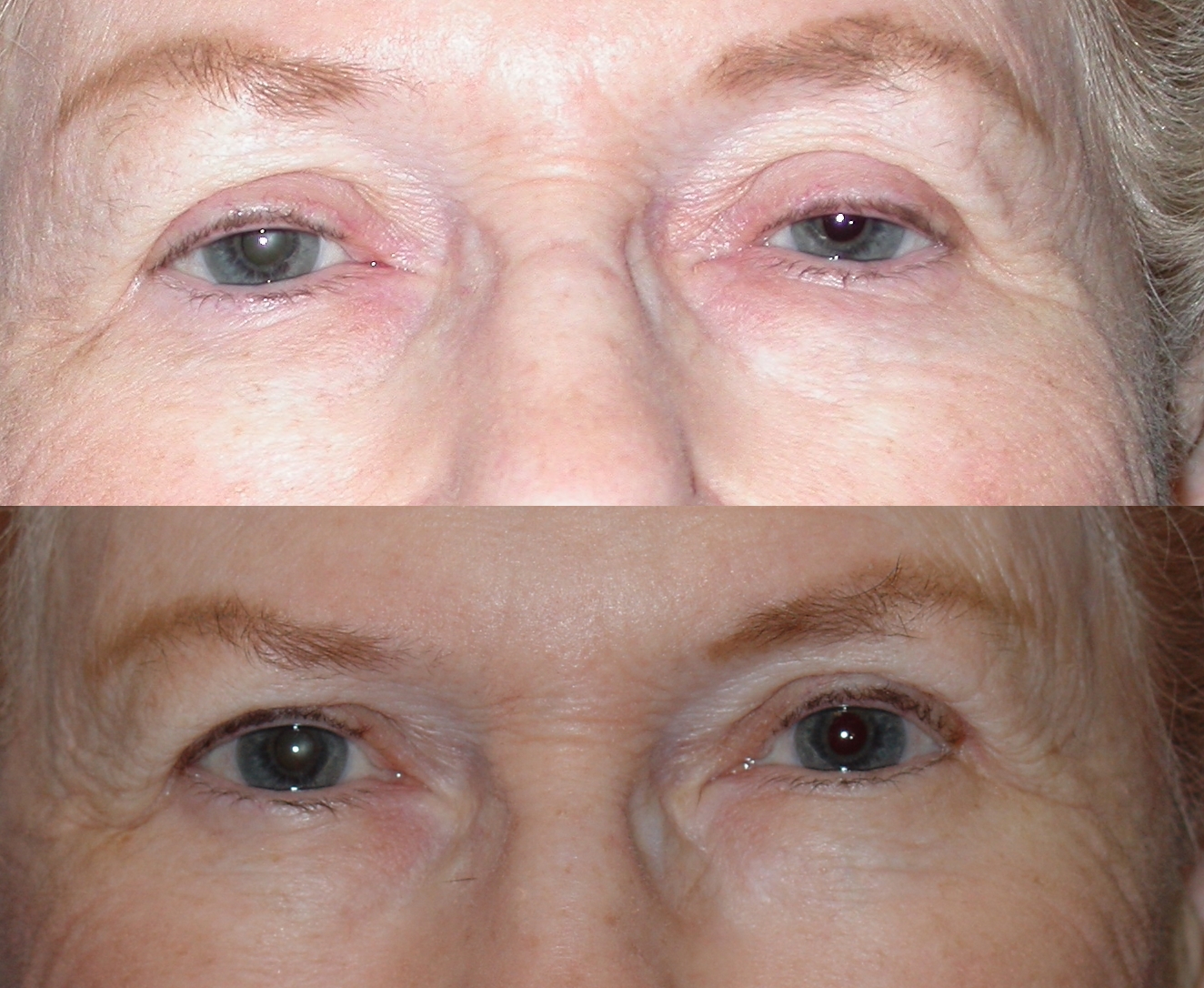 before and after ptosis/blepharoplasty