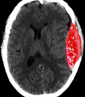 <p>Epidural Hematoma After Trauma, Computed Tomography