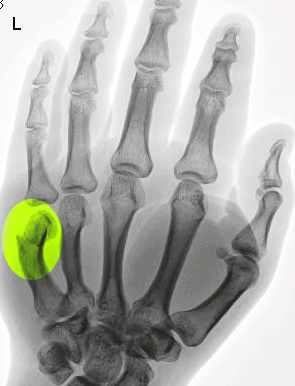boxer fracture of left hand