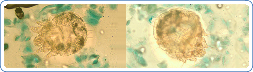 <p>Scabies in Skin Scraping</p>