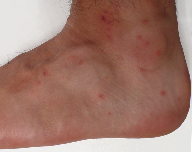 Dermatological findings from multiple chigger bites