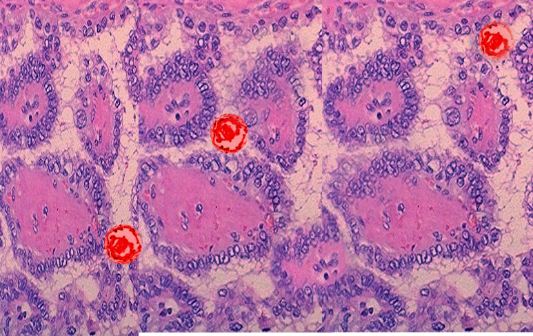 Papillary thyroid cancer psammoma body