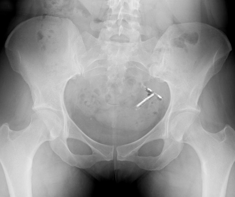 Intrauterine device malposition