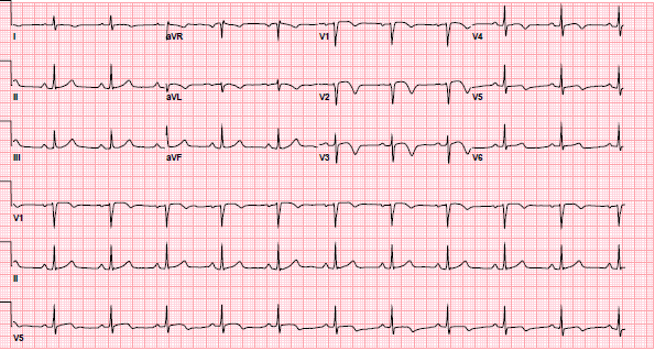 <p>Wellens Syndrome