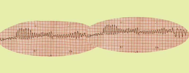 torsade de pointes