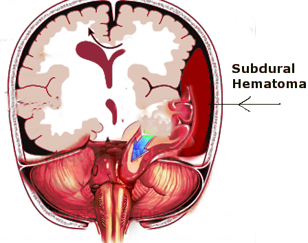 Subdural hematoma and uncal herniation