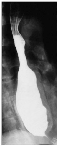 Barium swallow showing achalasia
