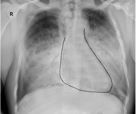 <p>Congestive Heart Failure, Radiograph