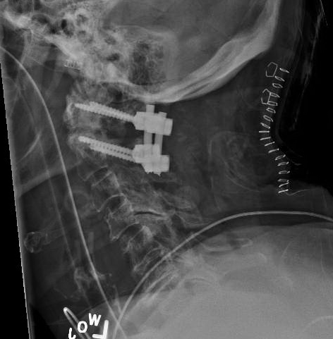 C1-C2 posterior fixation