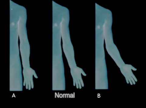 cubitus varus and valgus