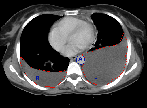 CT scan of chest effusions