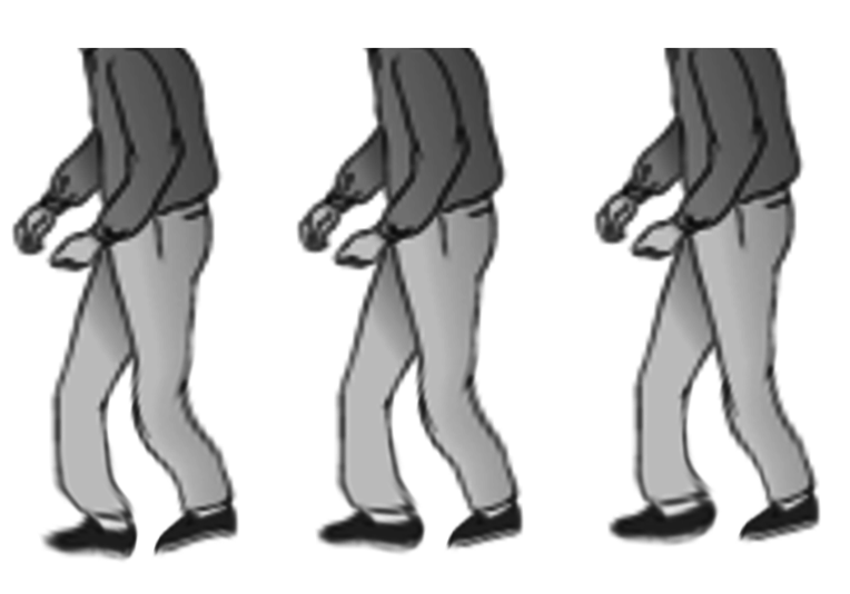 Shuffling gait in parkinson disease