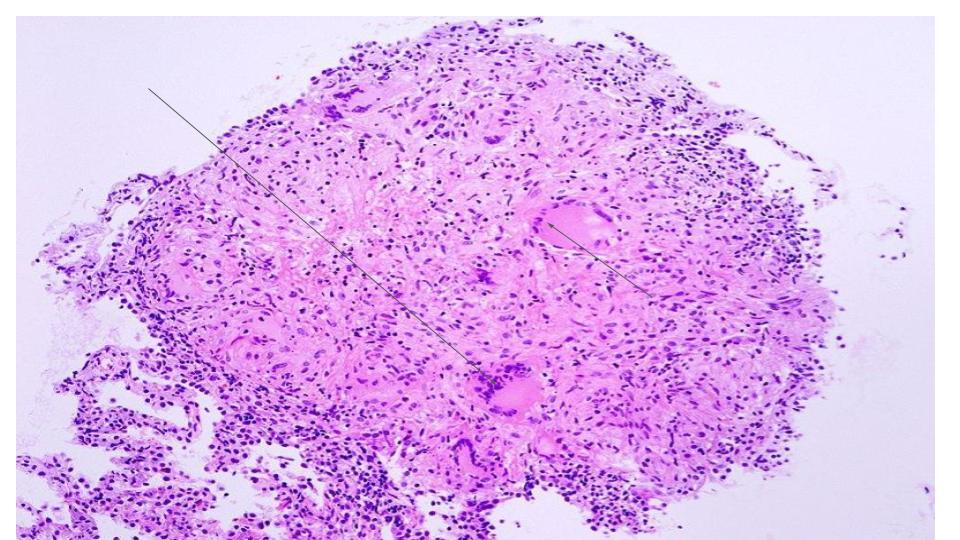   Granuloma of Tuberculosis. Arrows pointed at multi-nucleated giant cells.