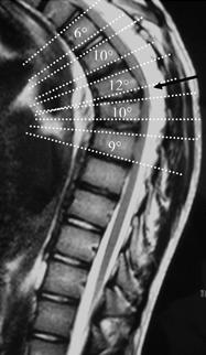 Sagittal MRI demonstrating anterior wedging of >/= 5 degrees in 3+ adjacent vertebral bodies, as described in the diagnostic criteria for Scheuermann's kyphosis. 