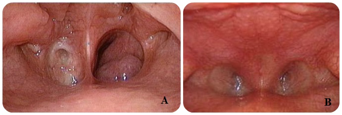 A: Unilateral choanal atresia; B: Bilateral choanal atresia